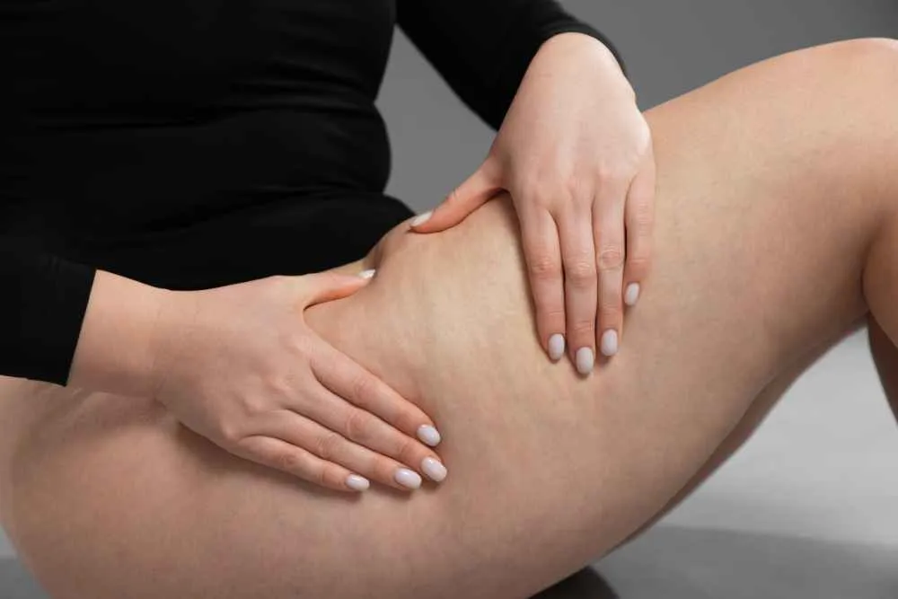 Celulitis: cómo intentar evitarla y hacer que desaparezca